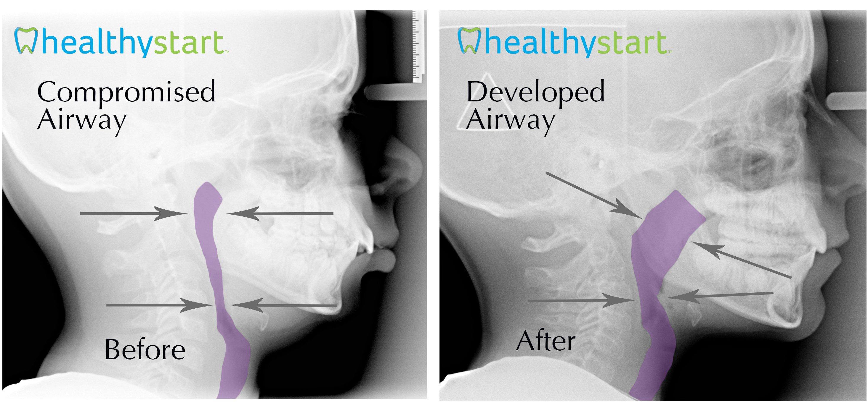 airway before and after