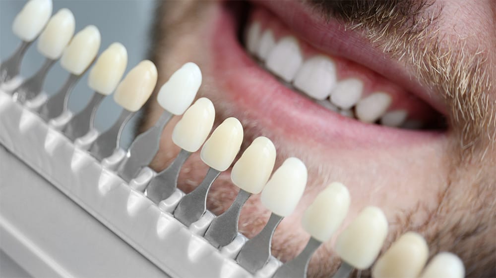A smiling man’s teeth compared to various dental veneer shades on a color guide