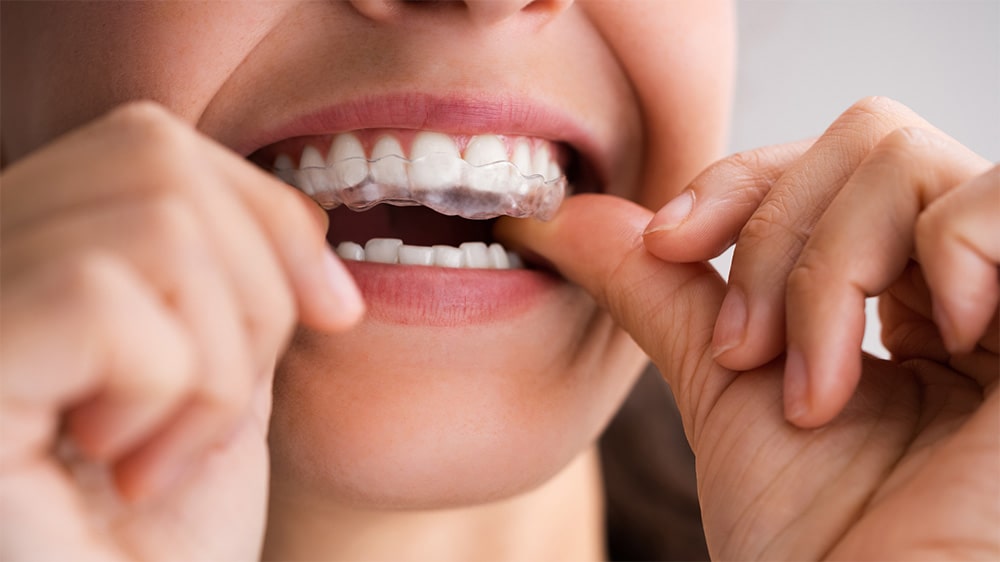 Close-up of a woman inserting a clear dental aligner into her mouth